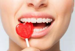 What Candy Can You Eat with Braces?
